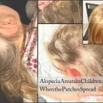 Alopecia Areata in Children: What Happens When the Patches Spread