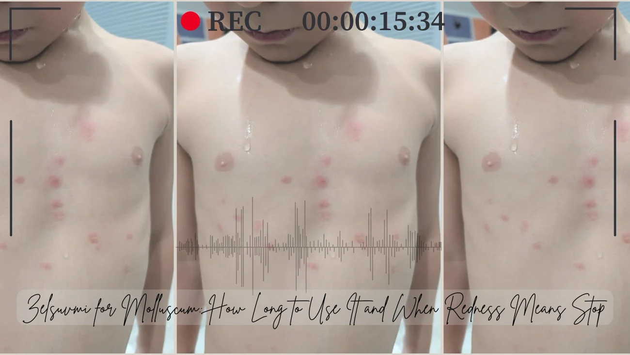 Zelsuvmi for Molluscum: How Long to Use It and When Redness Means Stop