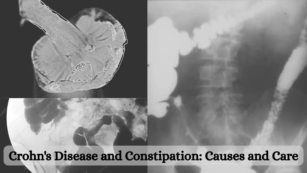 Crohn's Disease and Constipation: Causes and Care