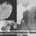 Crohn's Disease and Constipation: Causes and Care